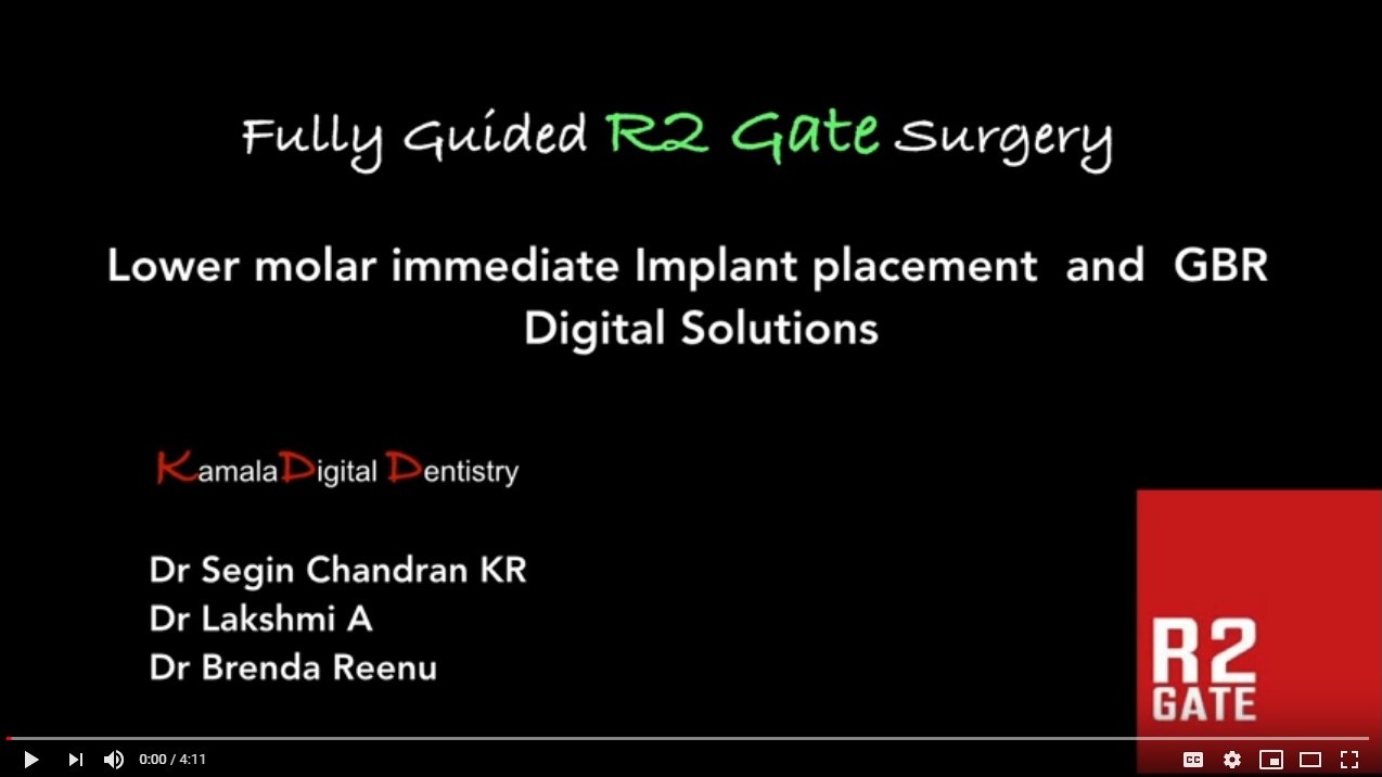 Digital Implant Surgery