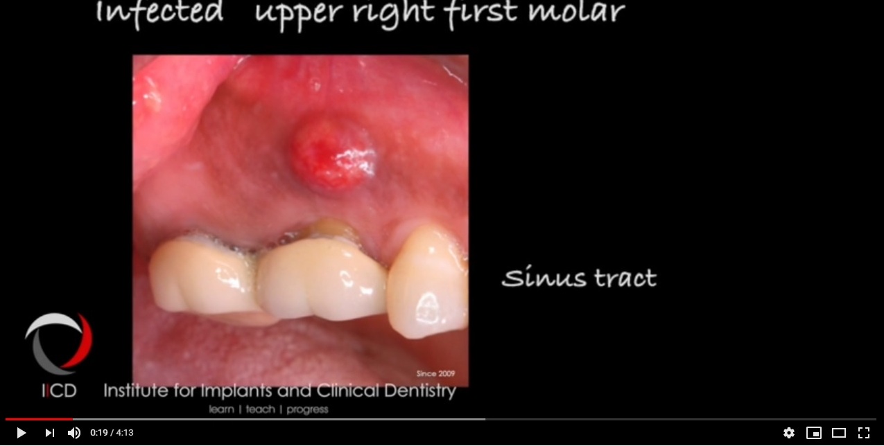 Implant in infected socket - Dr. Segin Chandran, India